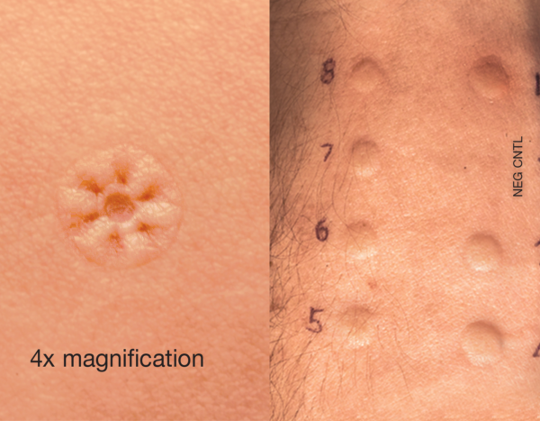 Ld multi test pc wheal reactions 1800x1200